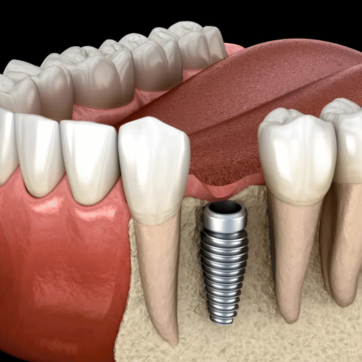 fromklickpincfpinbyeniopedrozoonodontologiavideo dentalimplantsdentalvideosemergencydentalcare ezgif.com video to gif converter 2